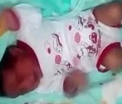 عزل ۳ مسئول در ماجرای سوخته شدن پای نوزاد ۶ روزه/ وزارت بهداشت خطای تیم درمانی را تایید کرد
