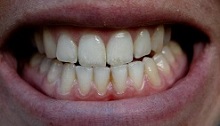 عوارض وحشتناک پودرهای سفید کننده روی دندان‌ها